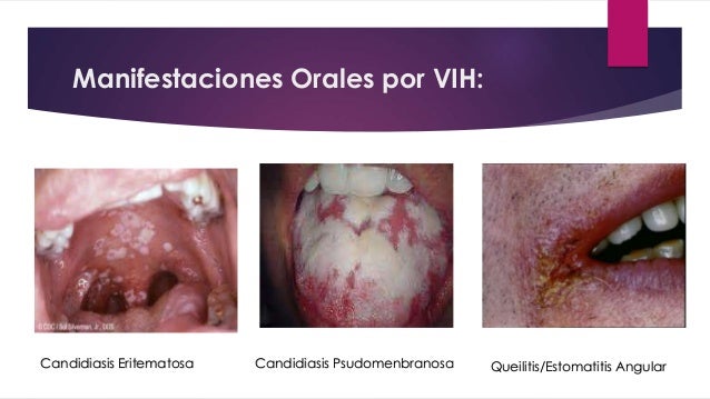 sexo oral y ets